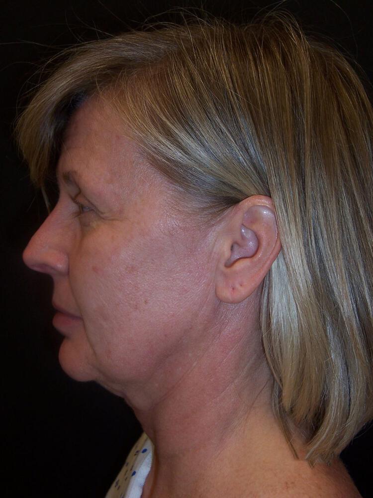 Facelift Before & After Image