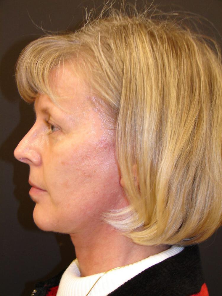 Facelift Before & After Image