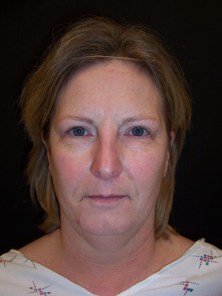 Facelift Before & After Image