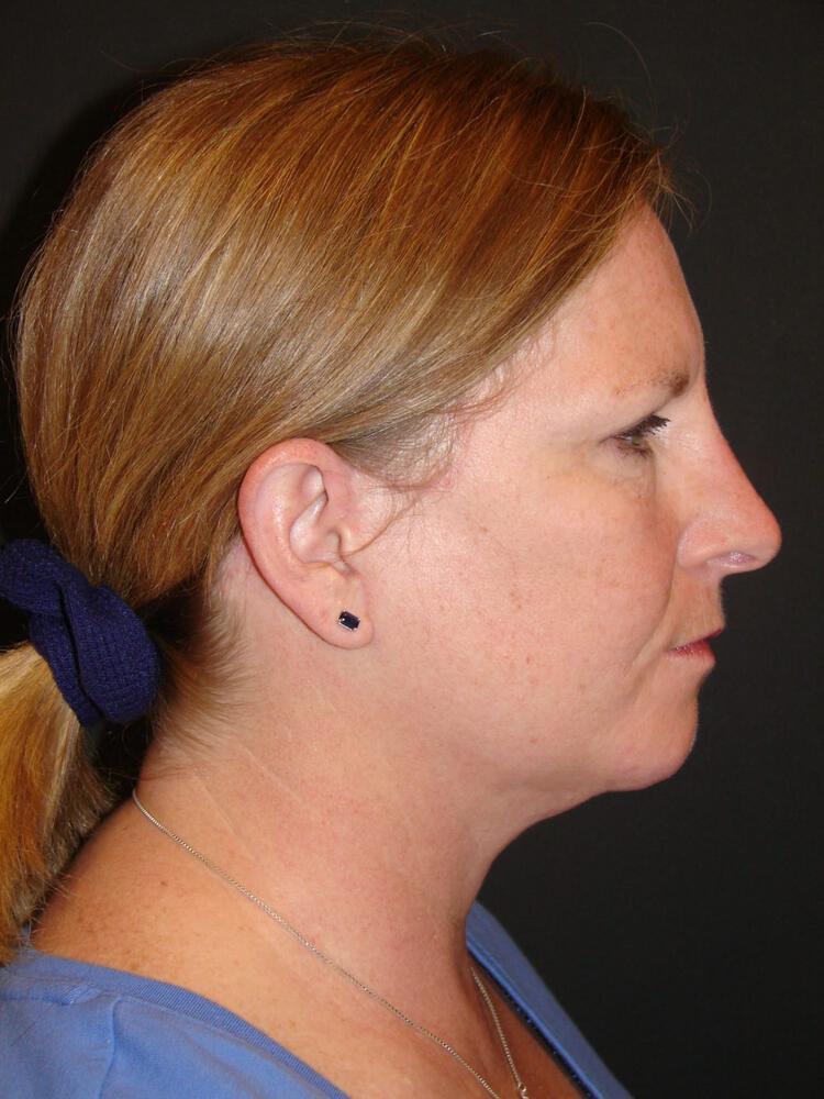 Facelift Before & After Image