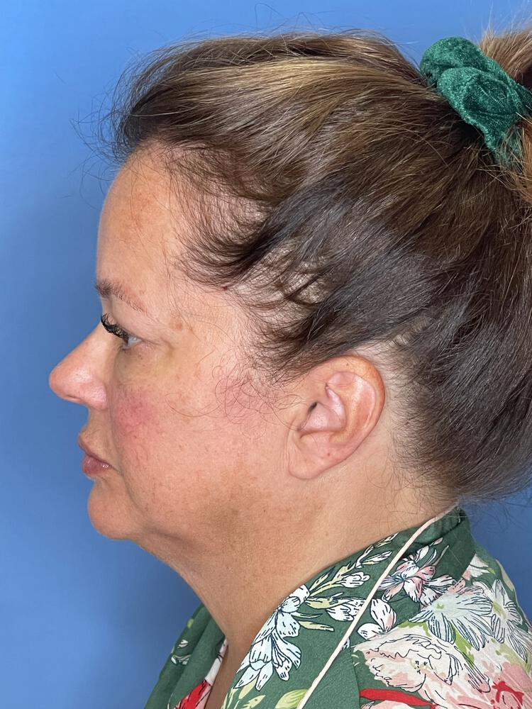 Facelift Before & After Image