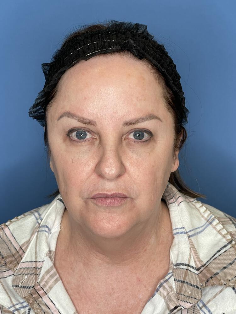 Facelift Before & After Image