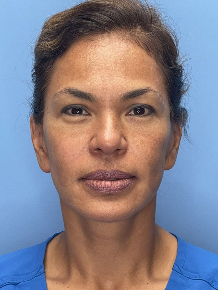 Facelift Before & After Image