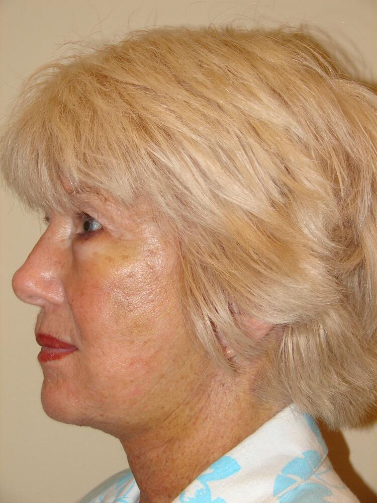 Facelift Before & After Image