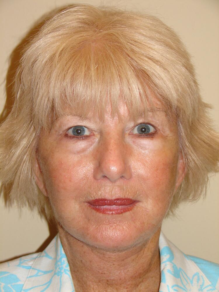 Facelift Before & After Image