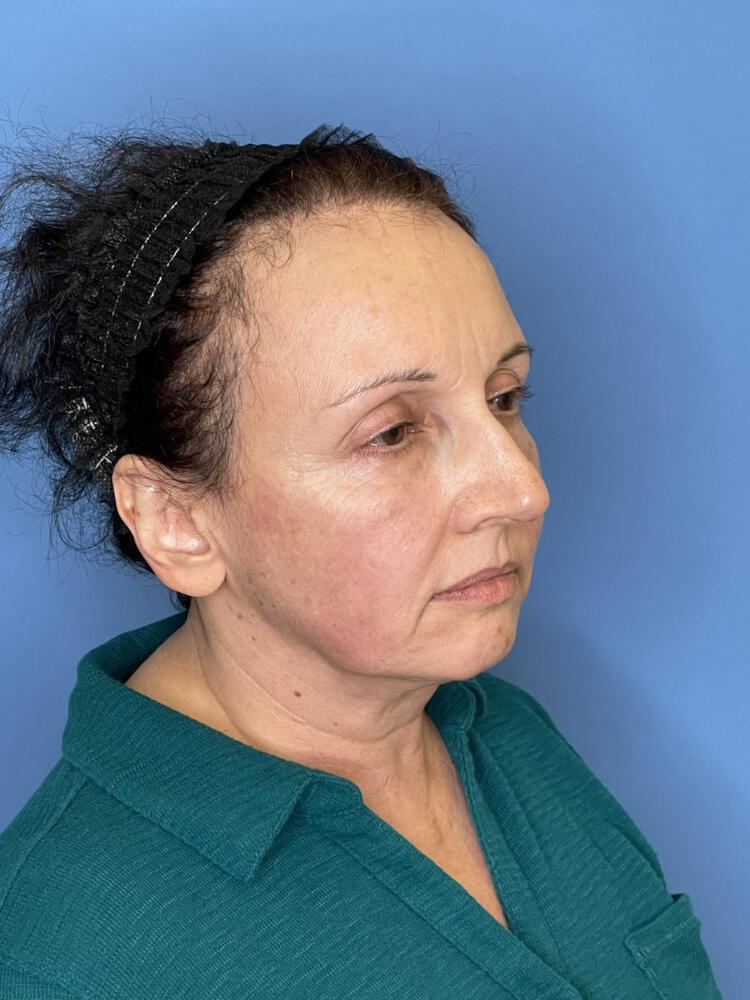 Facelift Before & After Image