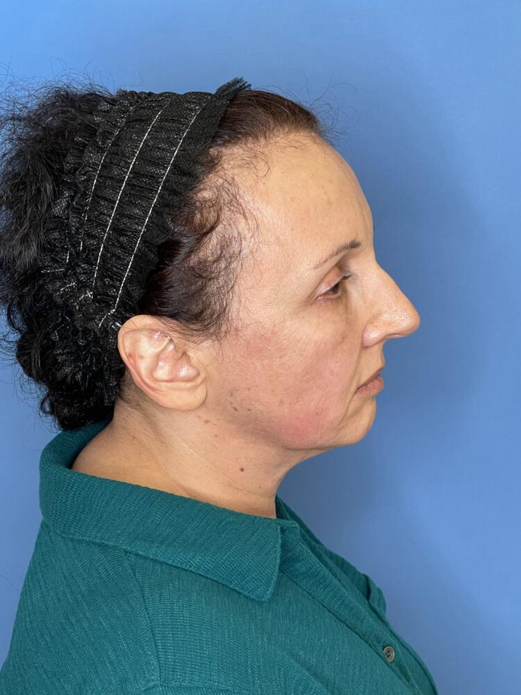 Facelift Before & After Image