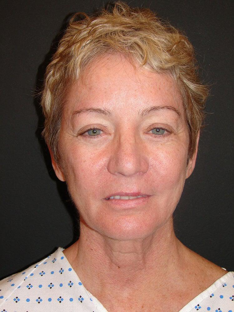 Facelift Before & After Image