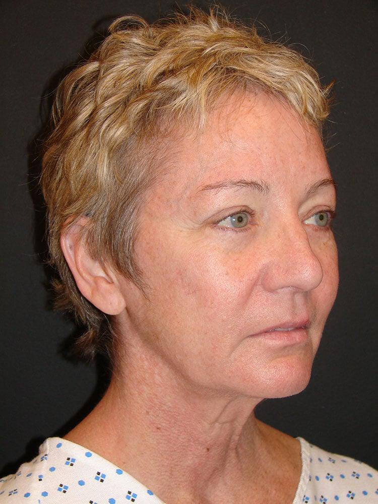 Facelift Before & After Image