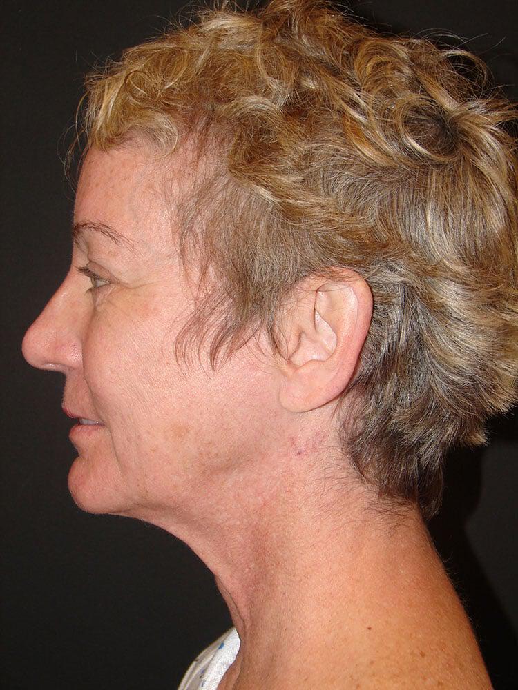 Facelift Before & After Image