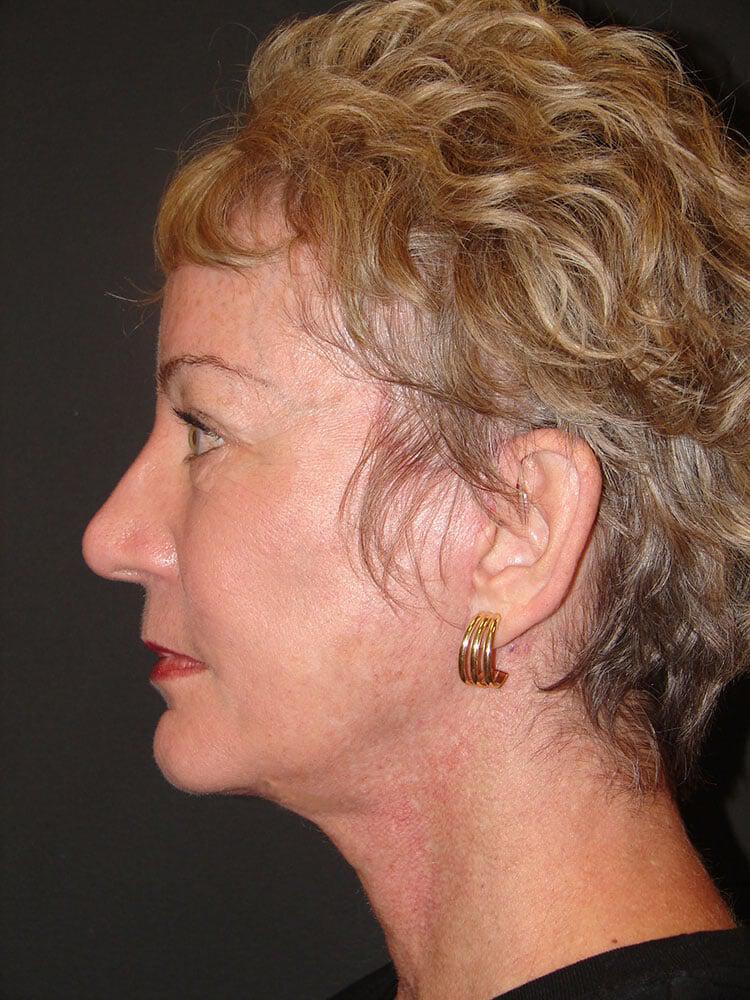 Facelift Before & After Image