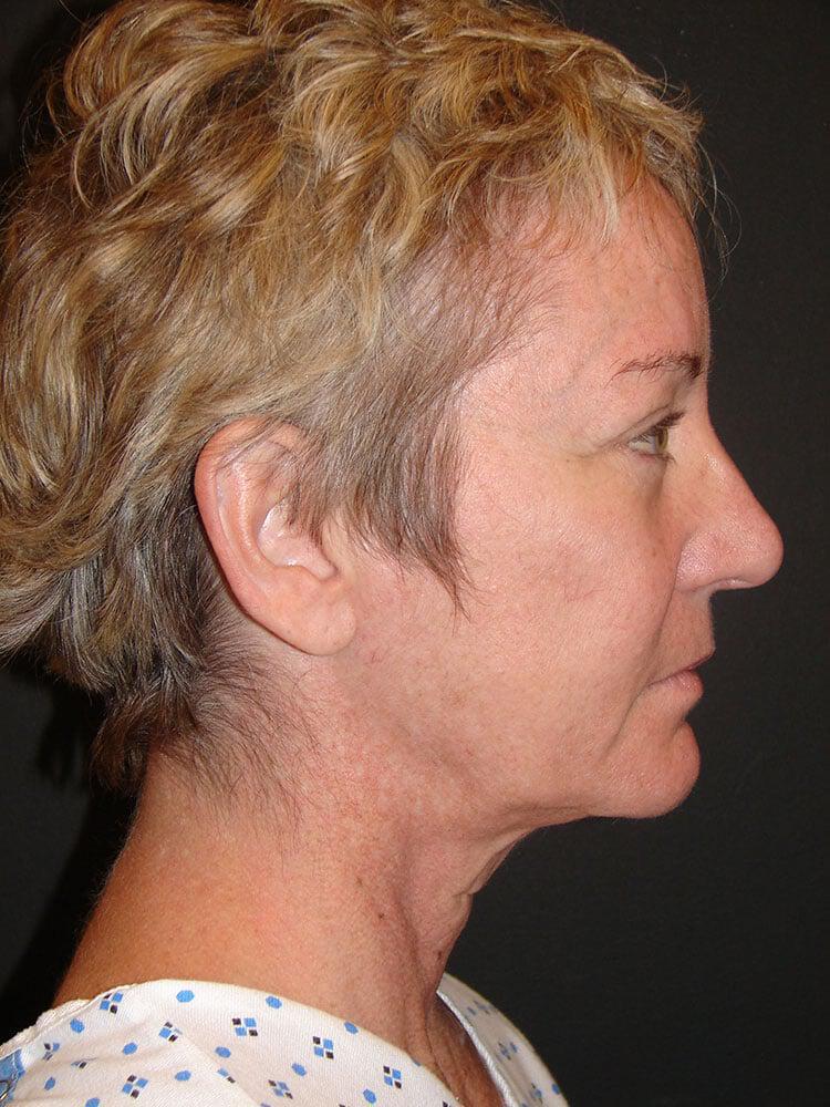 Facelift Before & After Image