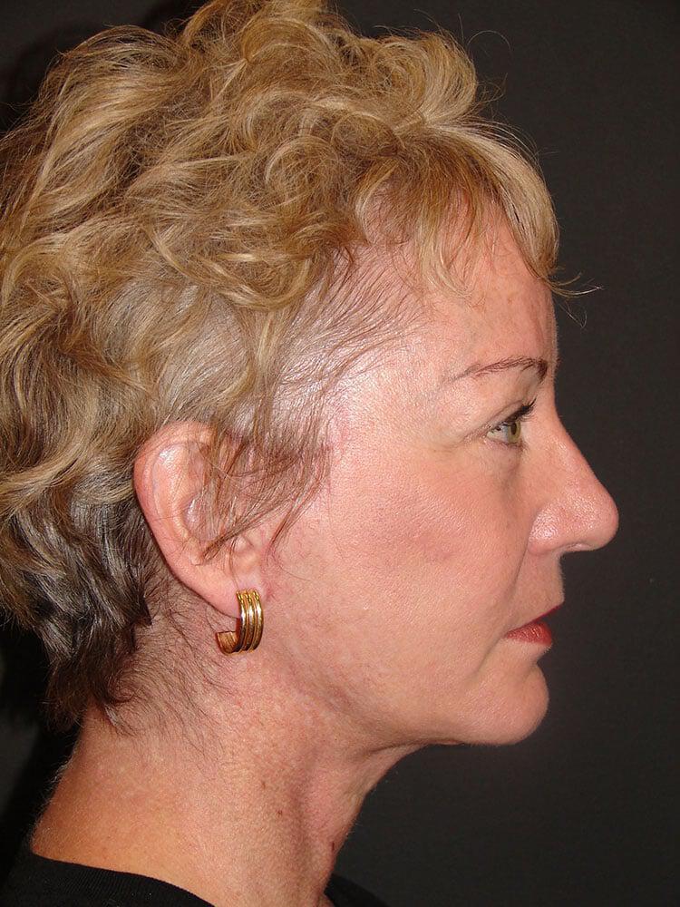 Facelift Before & After Image