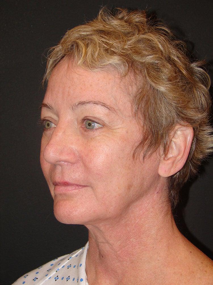 Facelift Before & After Image