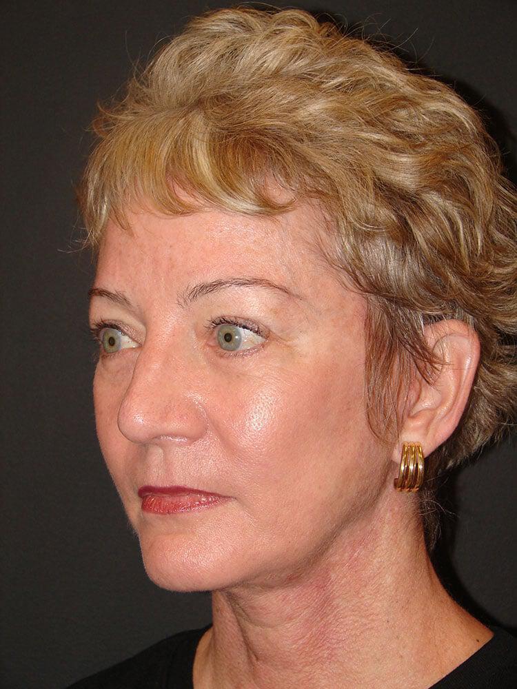 Facelift Before & After Image