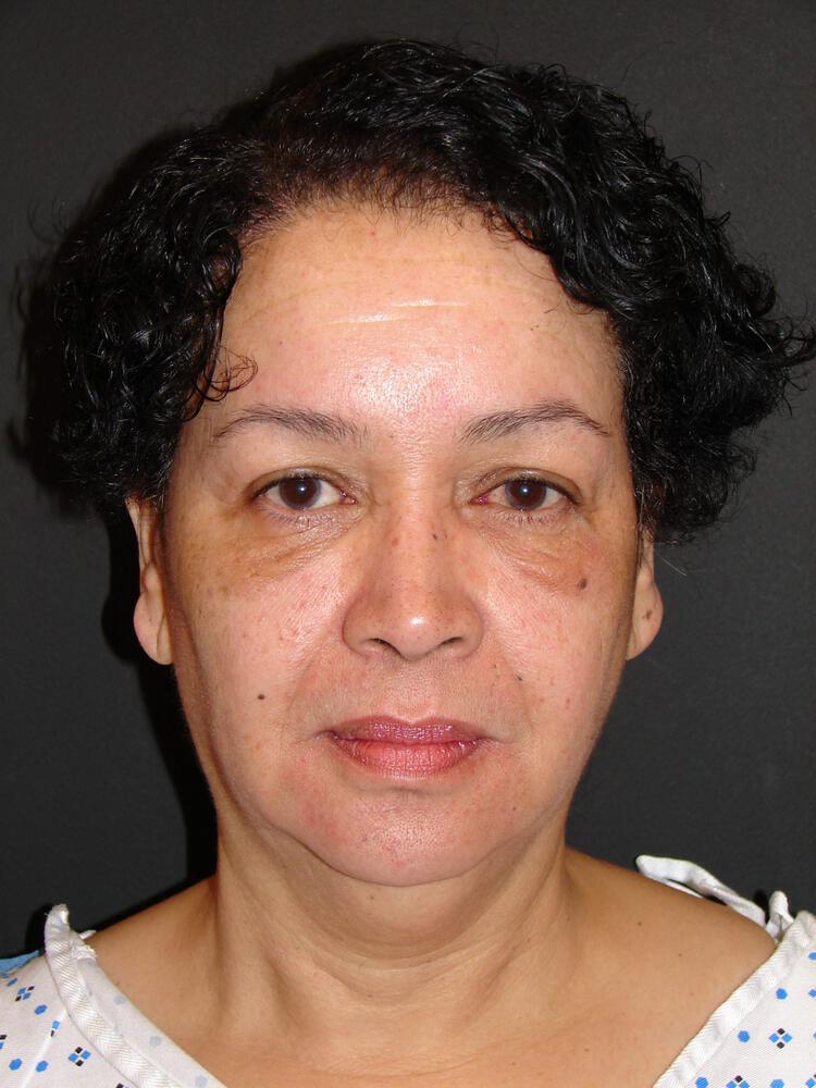 Facelift Before & After Image