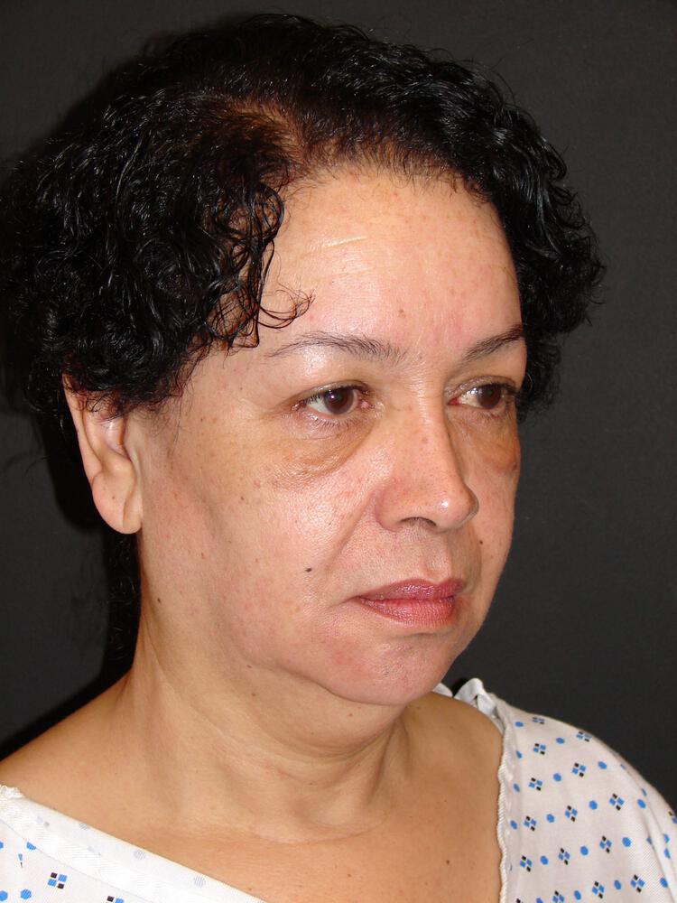 Facelift Before & After Image