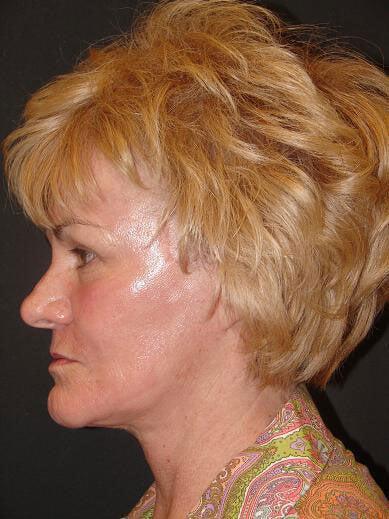 Facelift Before & After Image