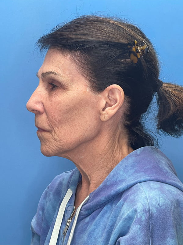 Facelift Before & After Image