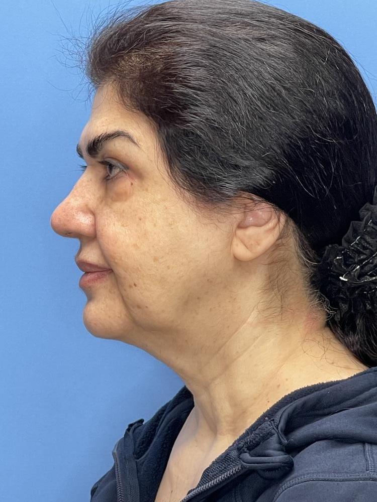 Facelift Before & After Image