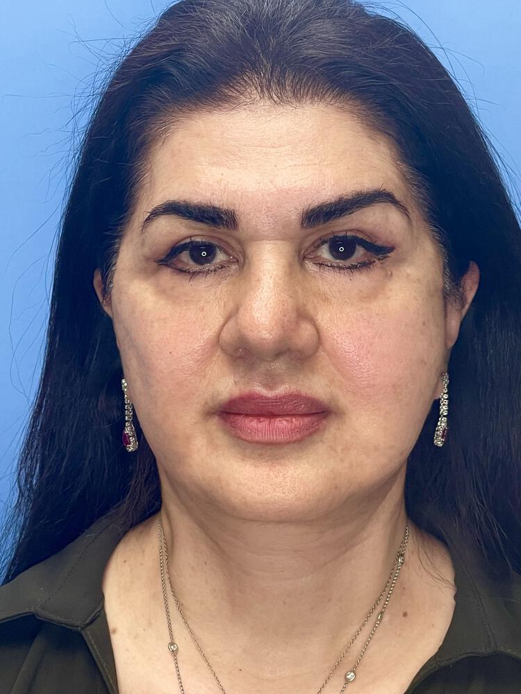 Facelift Before & After Image