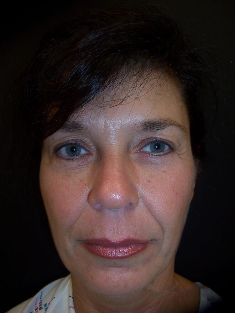 Facelift Before & After Image