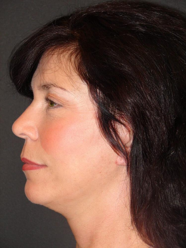 Facelift Before & After Image