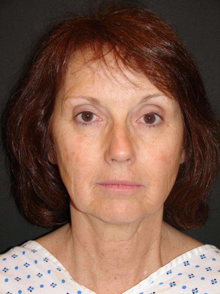 Facelift Before & After Image