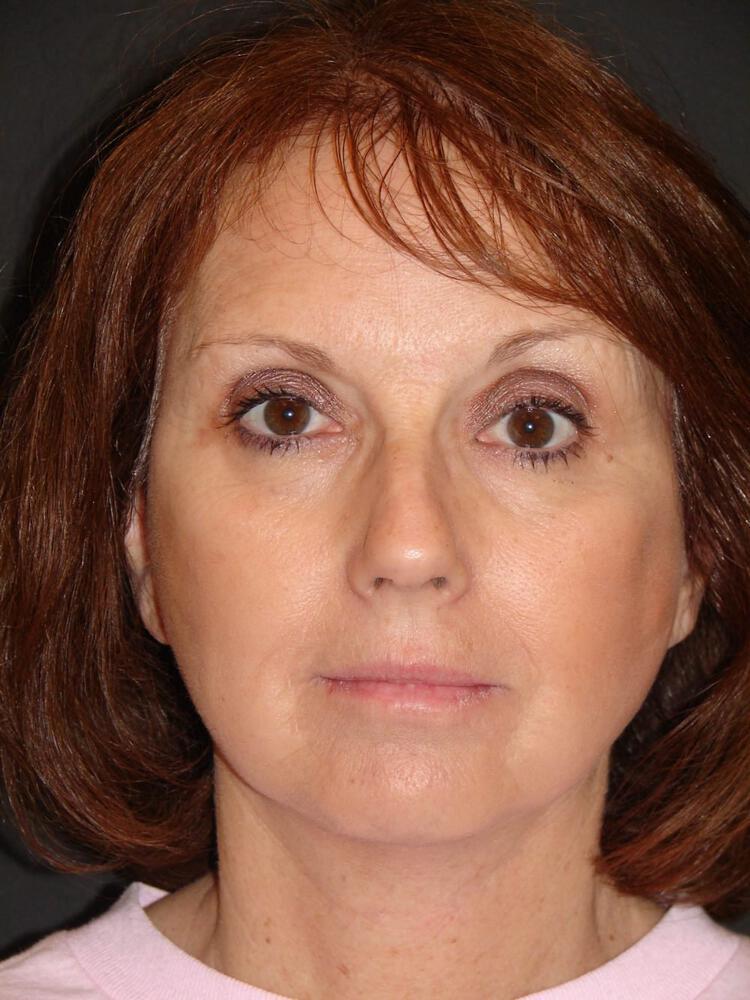 Facelift Before & After Image