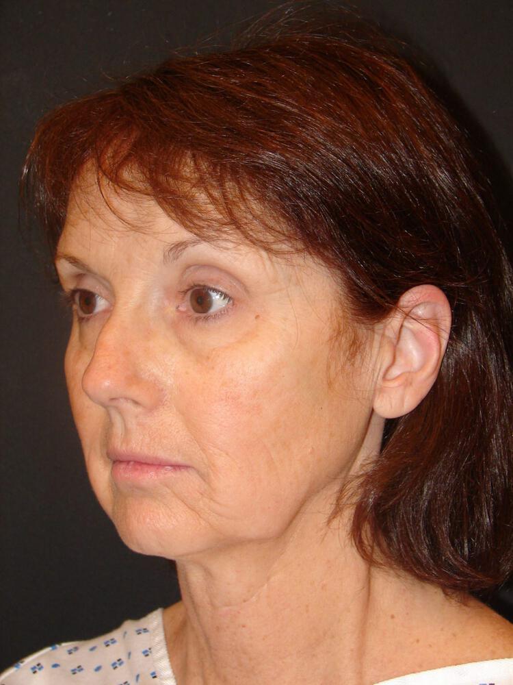 Facelift Before & After Image