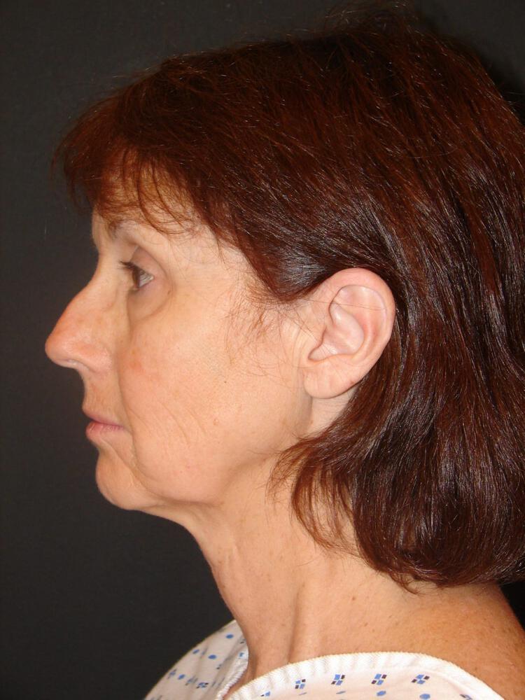 Facelift Before & After Image