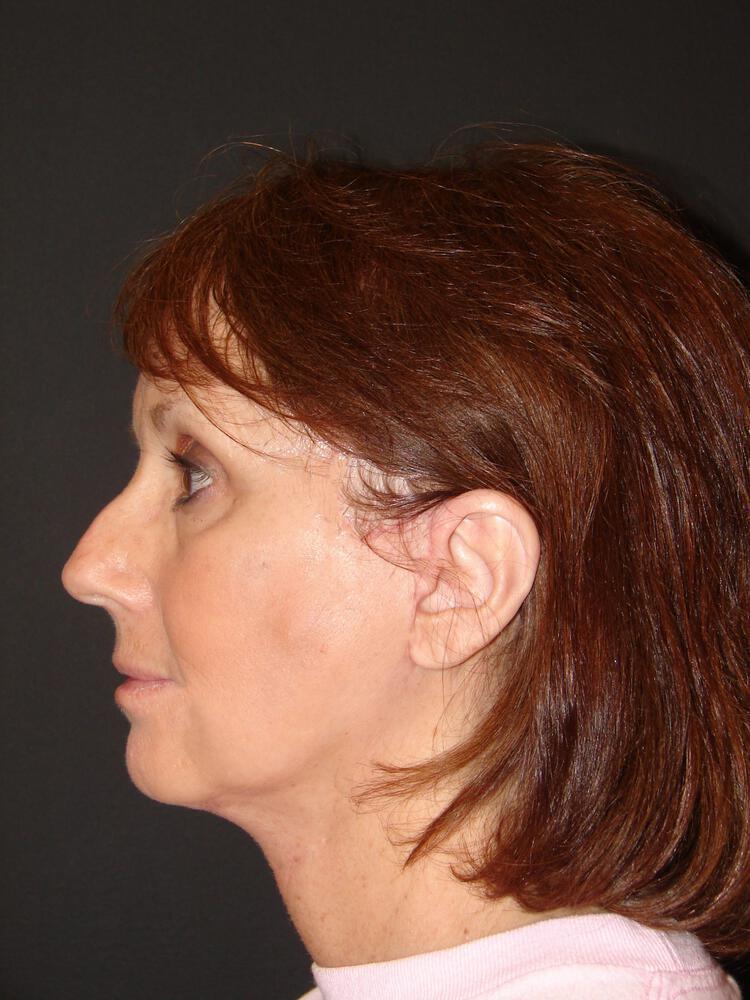 Facelift Before & After Image