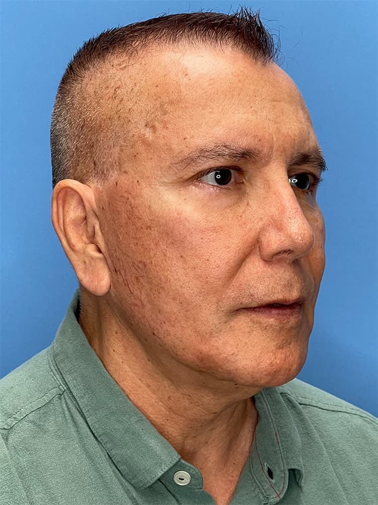 Facelift Before & After Image