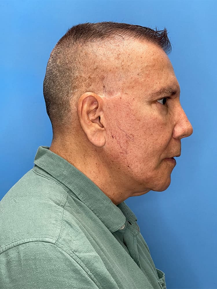 Facelift Before & After Image