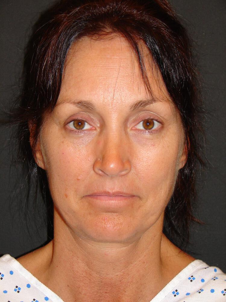 Facelift Before & After Image