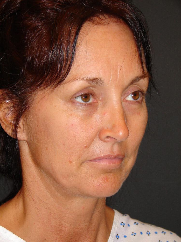 Facelift Before & After Image