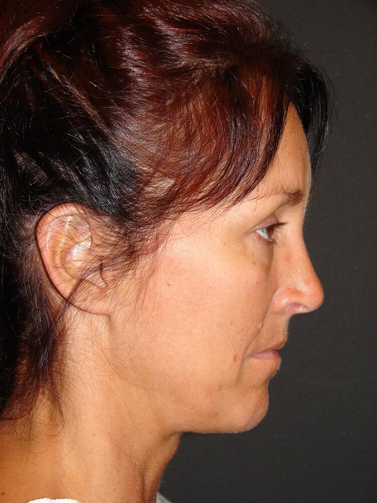 Facelift Before & After Image