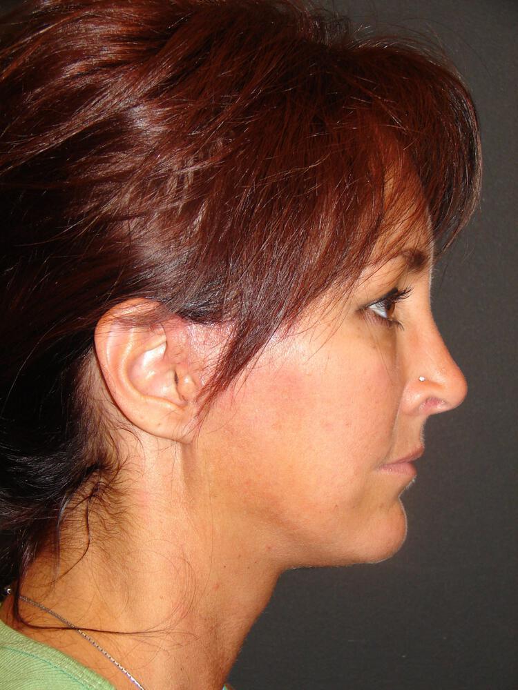 Facelift Before & After Image