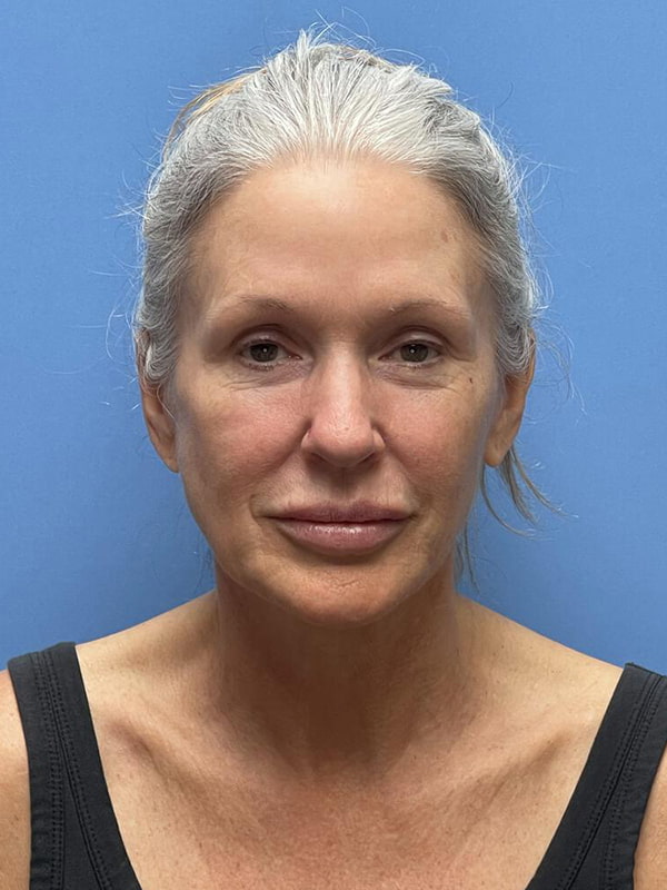 Facelift Before & After Image