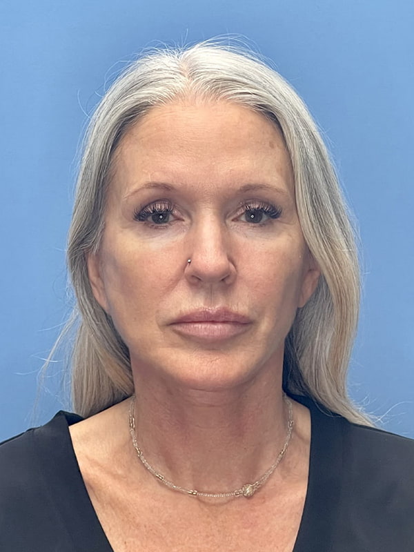 Facelift Before & After Image