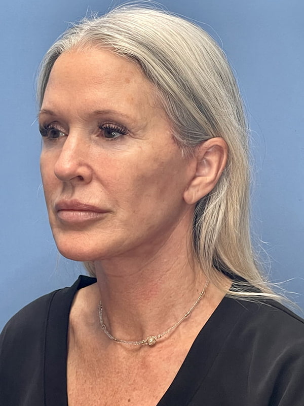 Facelift Before & After Image