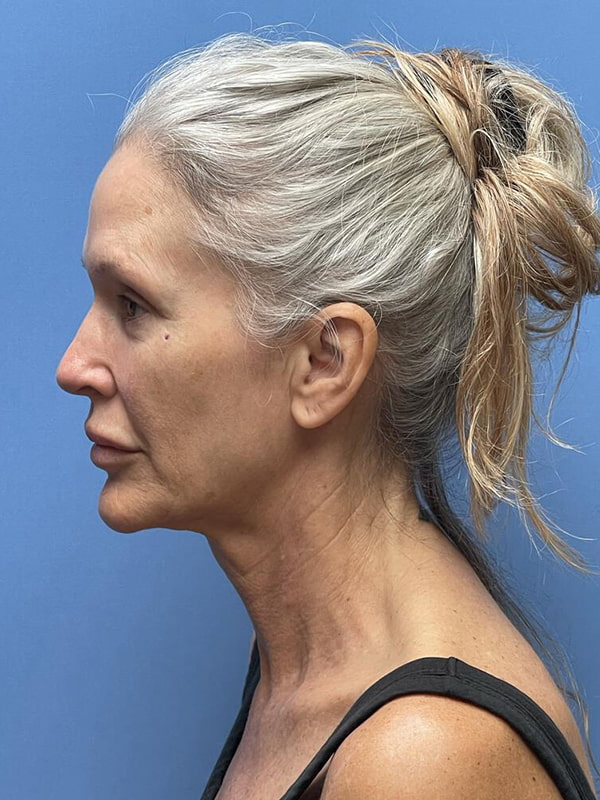 Facelift Before & After Image