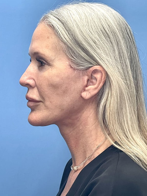 Facelift Before & After Image