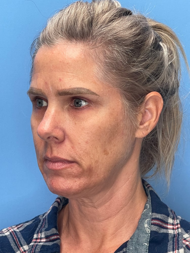 Facelift Before & After Image