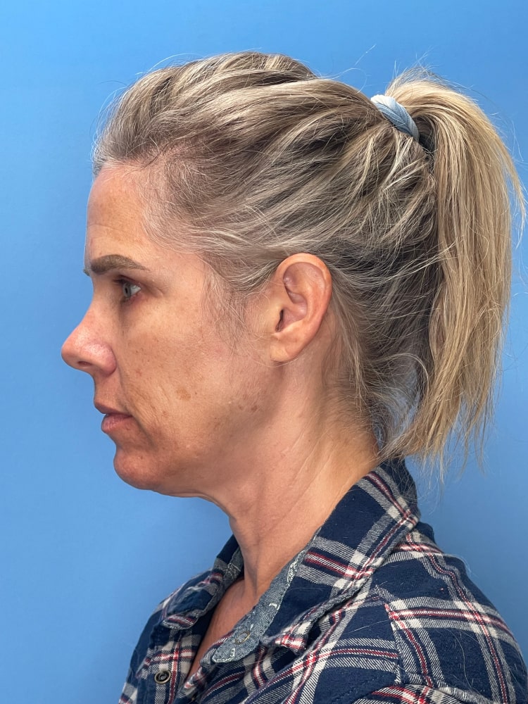 Facelift Before & After Image