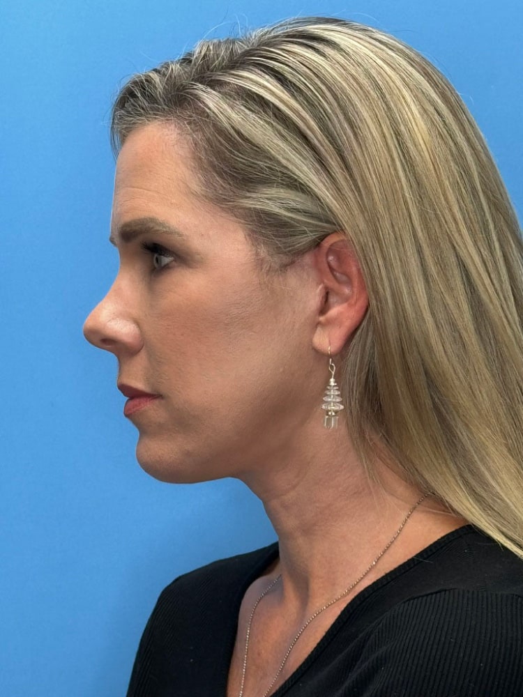 Facelift Before & After Image