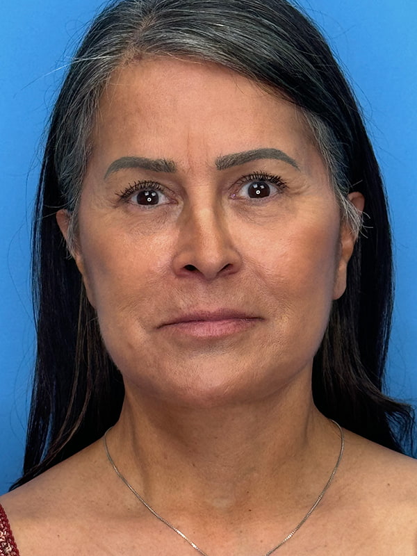 Facelift Before & After Image