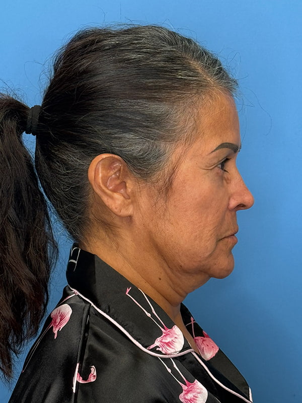 Facelift Before & After Image