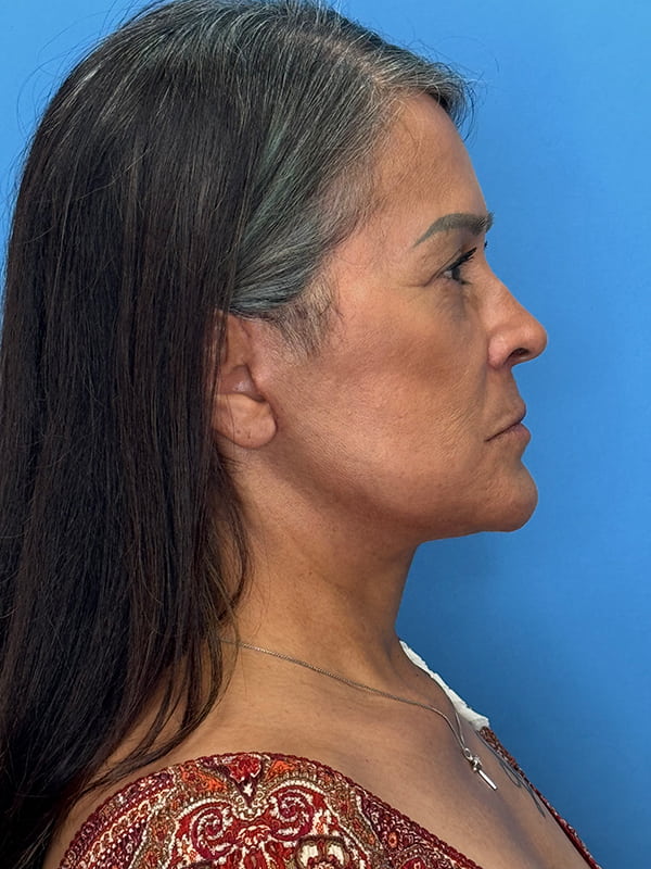 Facelift Before & After Image