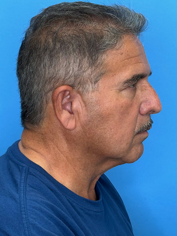 Facelift Before & After Image